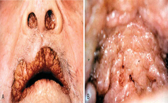 Figure 10 A, Verrucous carcinoma, intranasal and intraoral; B, Verrucous carcinoma, roof of mouth.
